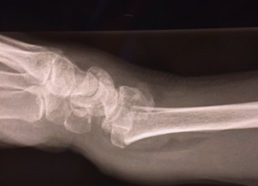 Figure four: Wrist fracture (X-ray) seen from the side view to show "dinner fork" deformity of Colles fracture. Click here to view a larger version.
