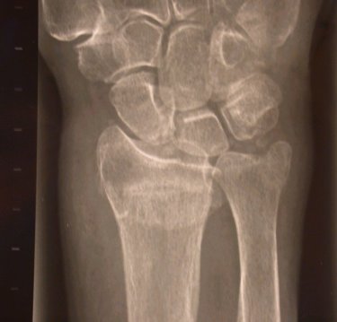Figure five: X-ray of Colles fracture seen from the front to show that the radius becomes shortened. Click here to view a larger version.