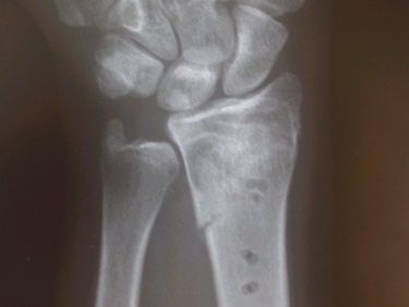 Figure seven. Reunite plate and Biobon in a fracture of the wrist (The plate is not visible on X-ray but the holes for the screw are). Click here to view a larger version.